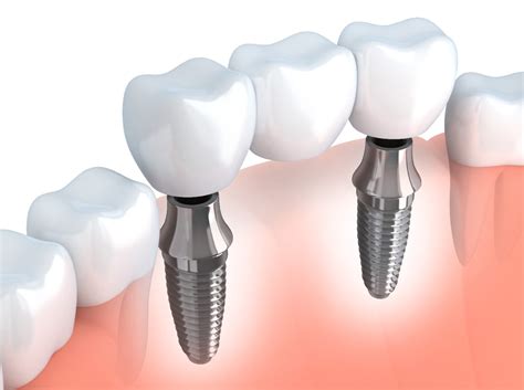 5 tipos de coroas dentárias para você conhecer – Dentaly